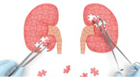 Renal Transplant